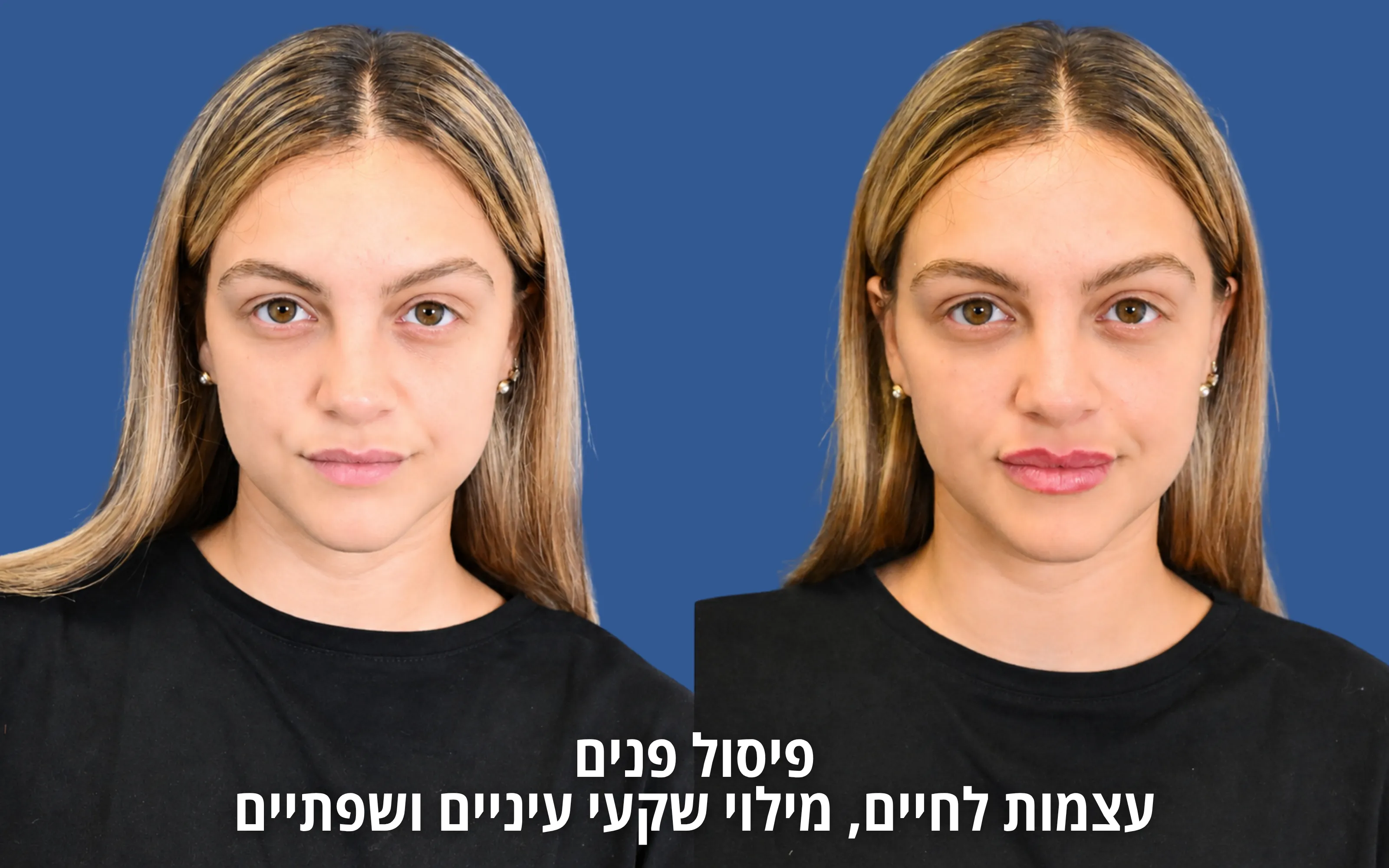 תוצאות הזרקות לפני ואחרי אצל ד״ר דוד טל