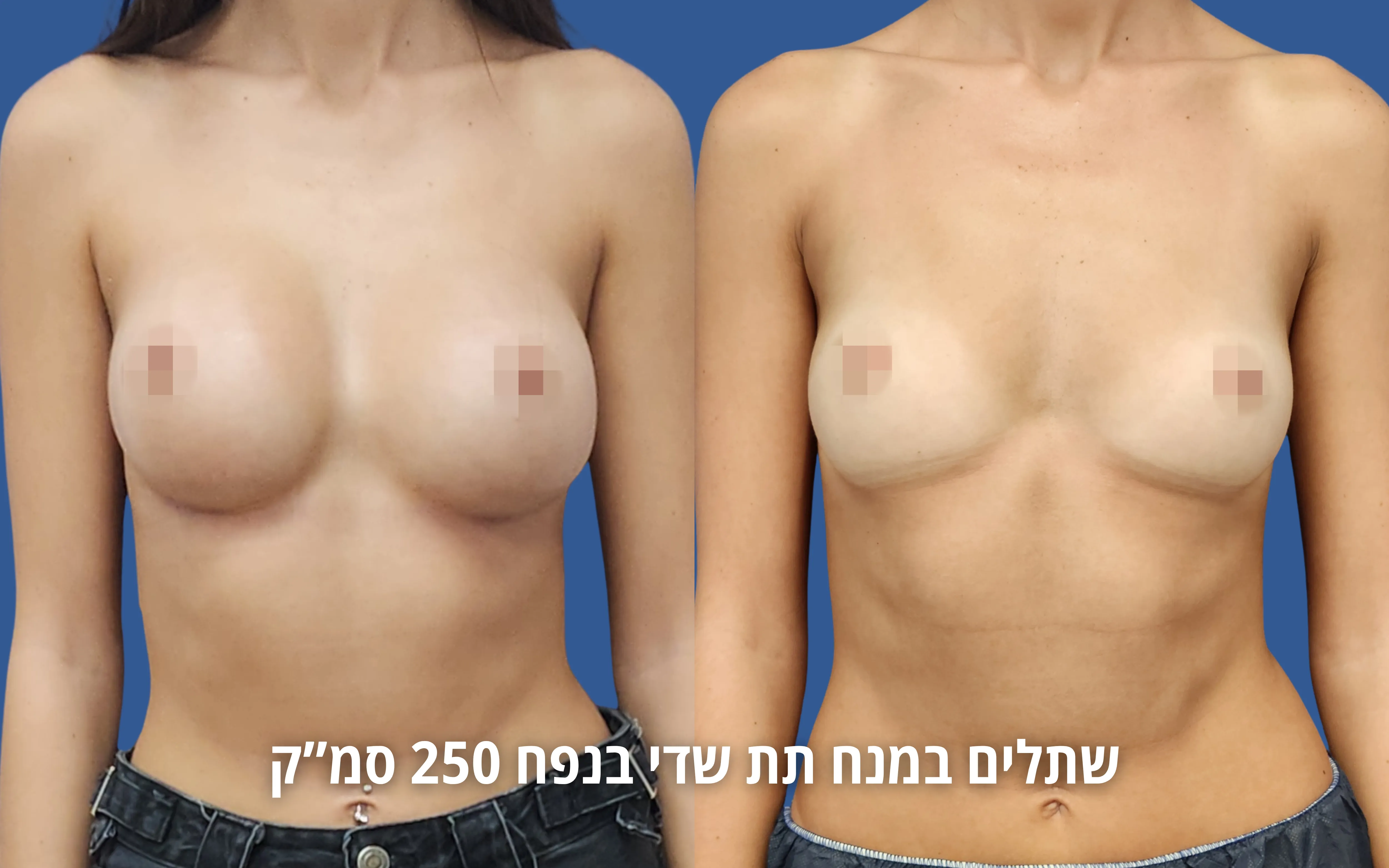 הגדלת חזה לפני ואחרי