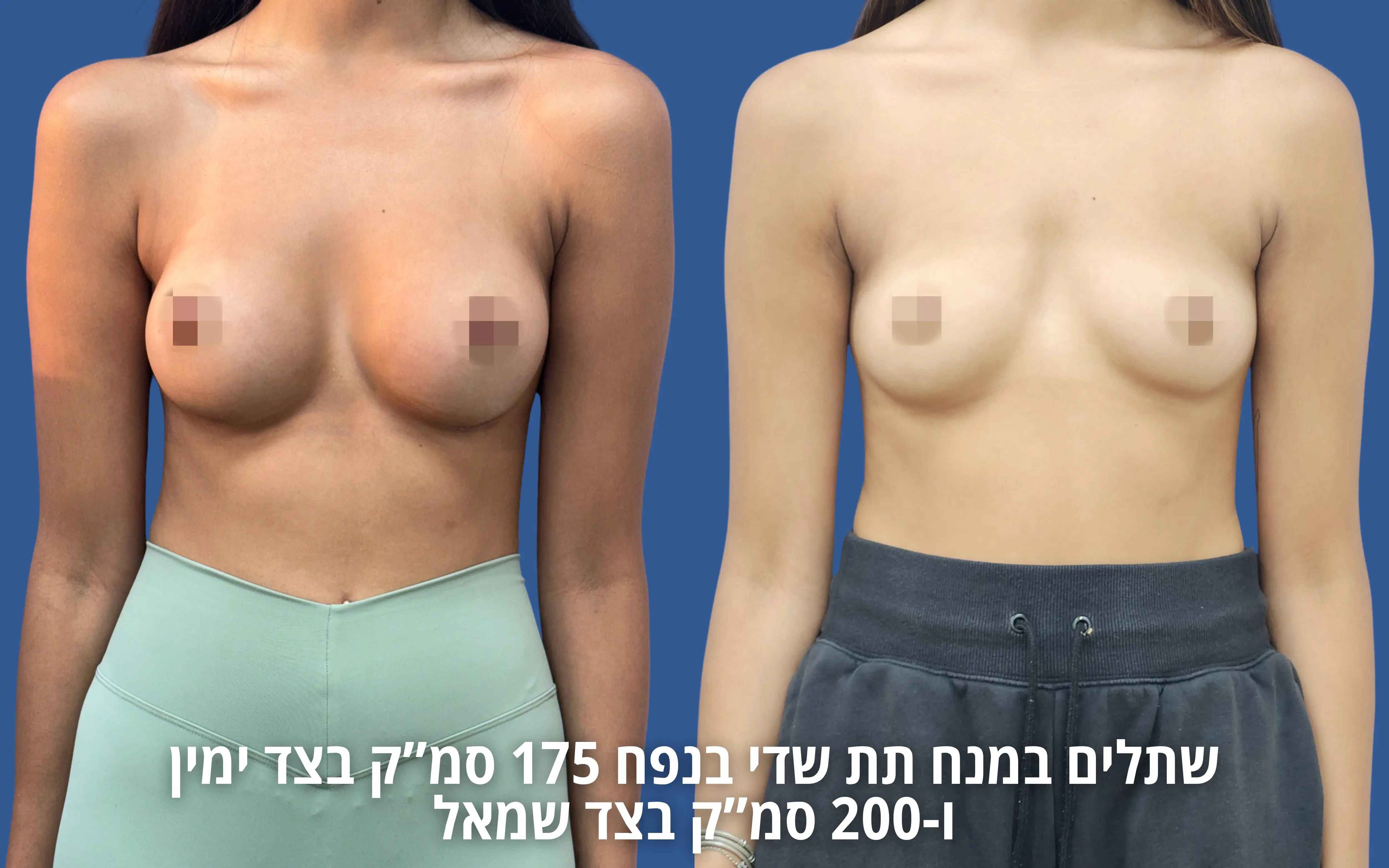 הגדלת חזה לפני ואחרי
