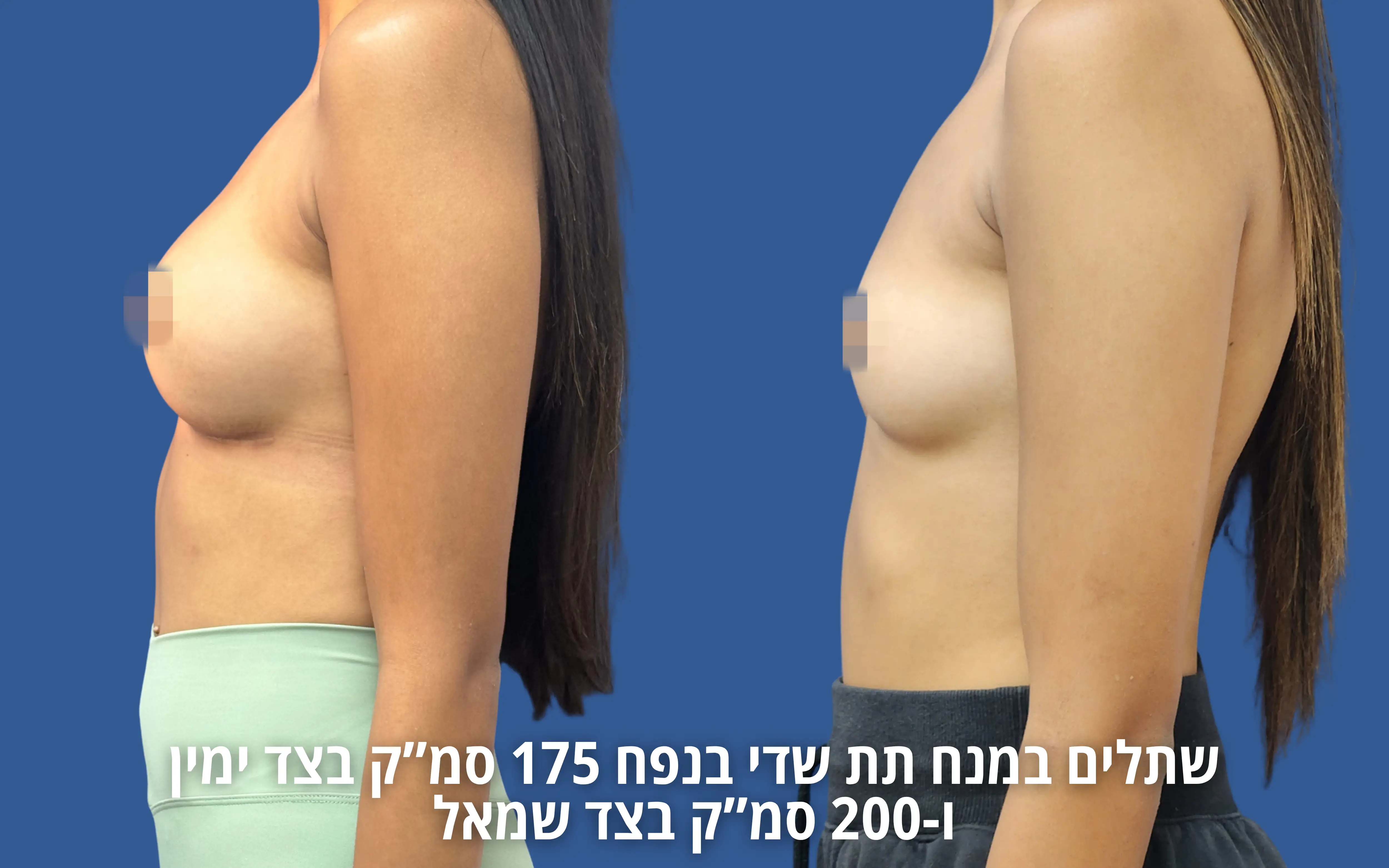 הגדלת חזה לפני ואחרי
