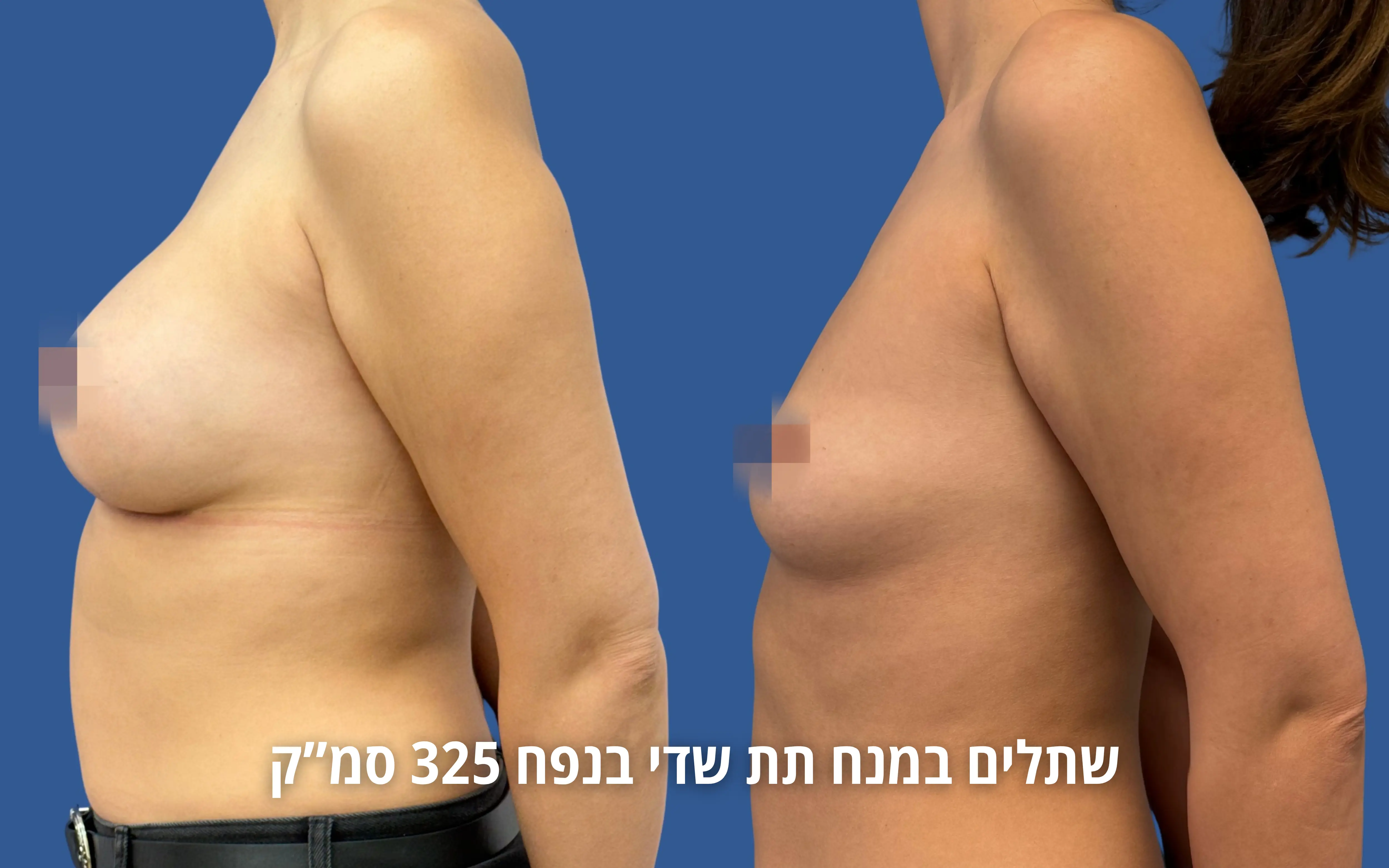 הגדלת חזה לפני ואחרי