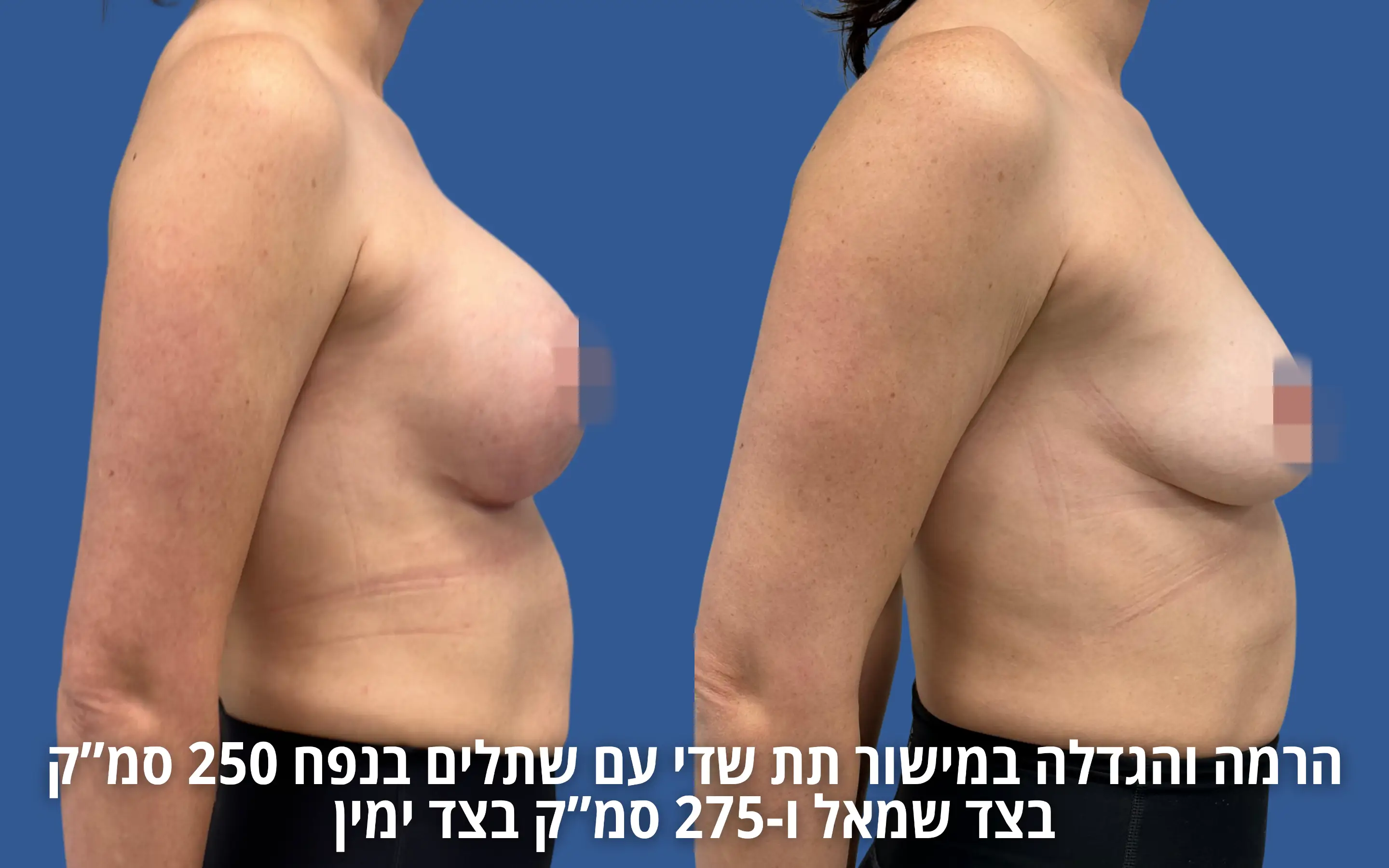 הרמת חזה עם שתל לפני ואחרי אצל ד״ר דוד טל