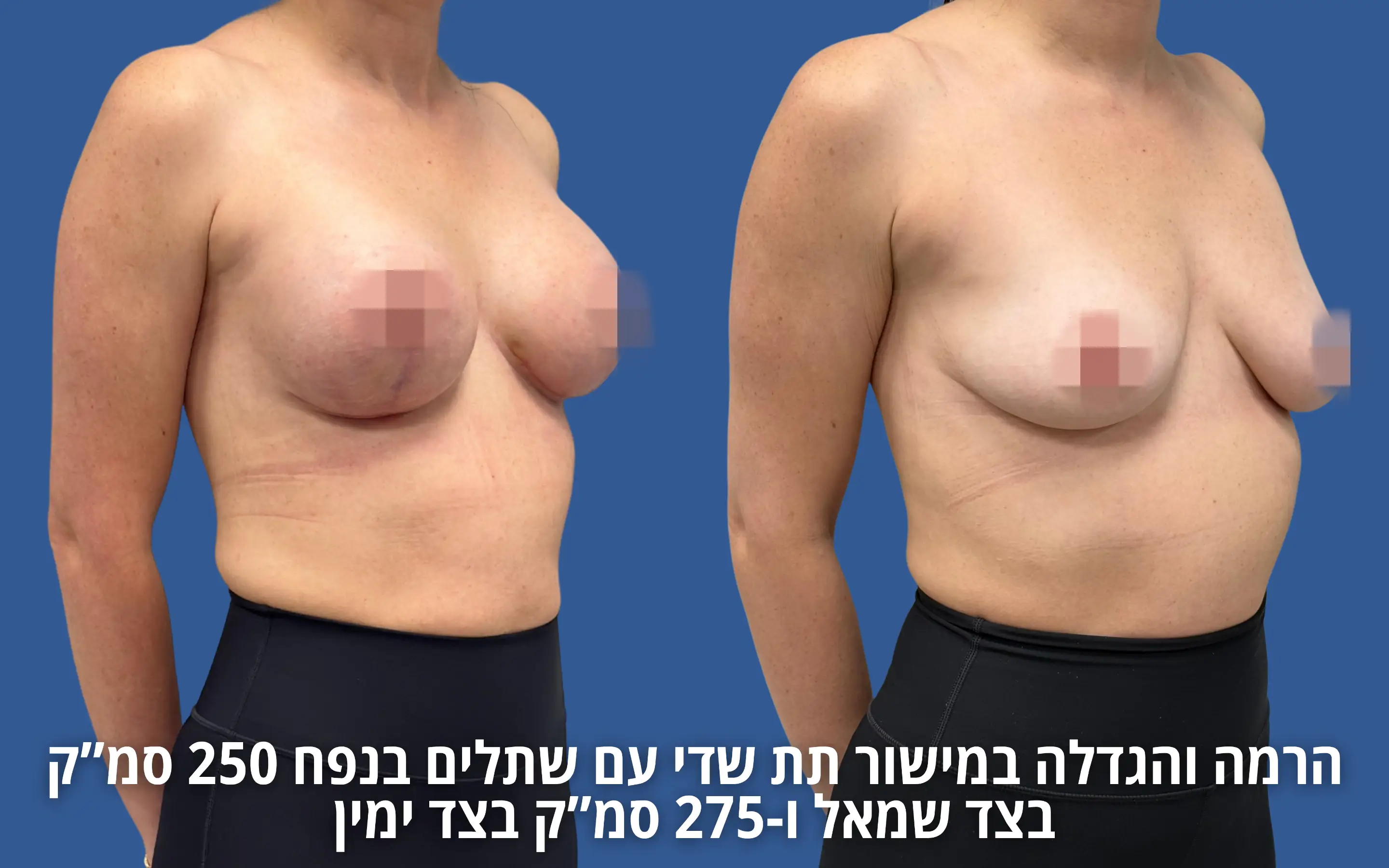 הרמת חזה עם שתל לפני ואחרי אצל ד״ר דוד טל
