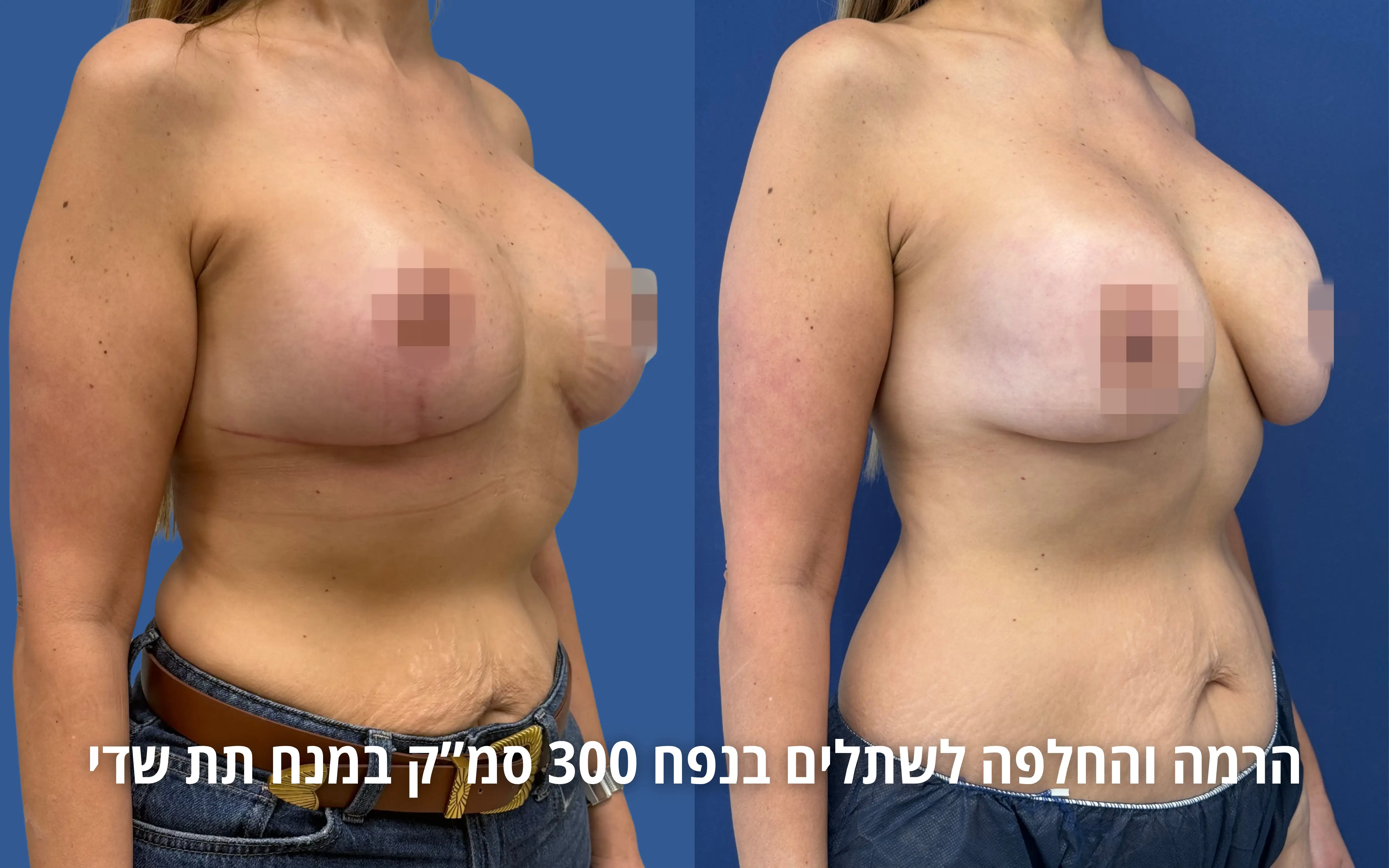 החלפת או הוצאת שתלים לפני ואחרי אצל ד״ר דוד טל