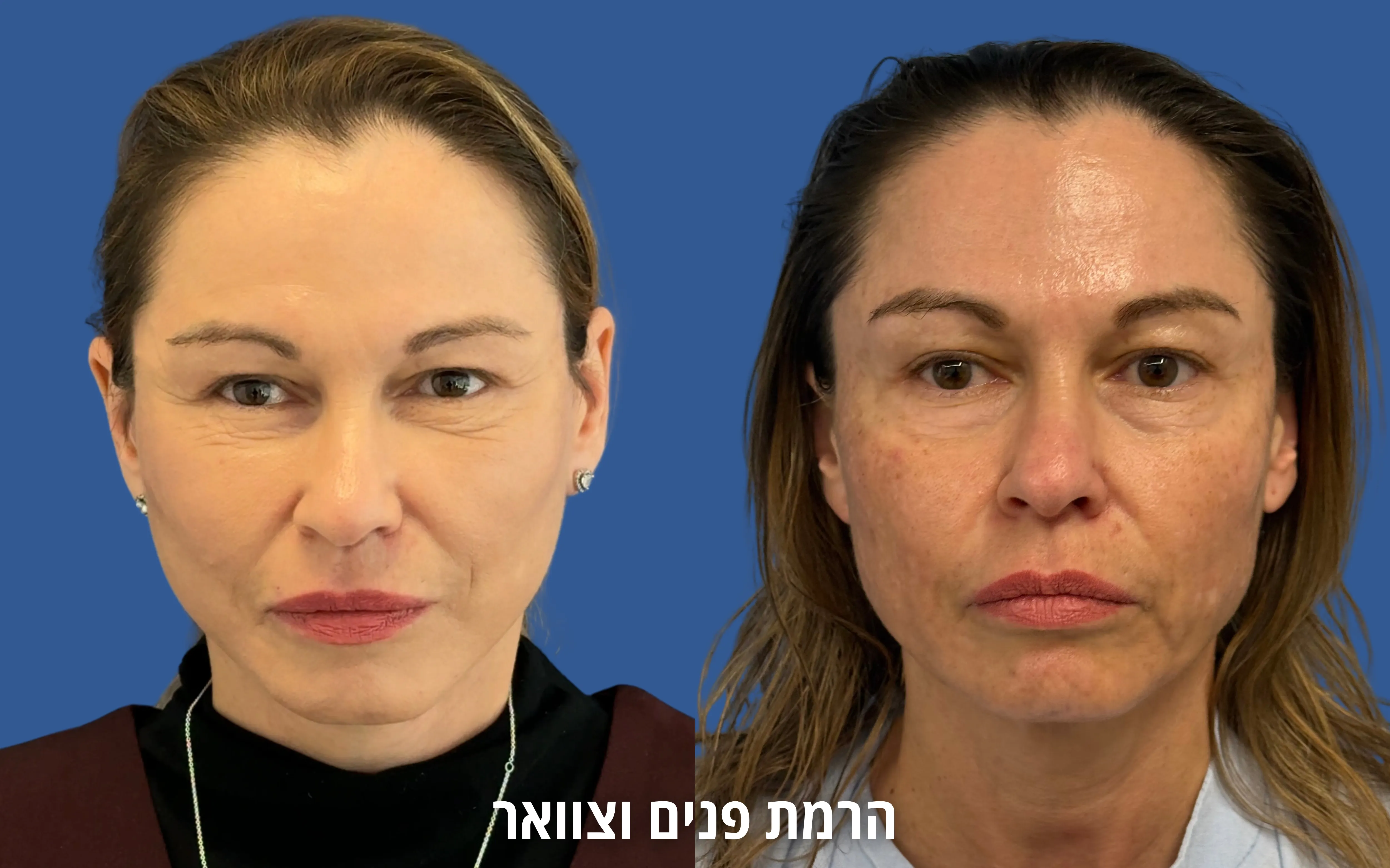 ניתוחי פנים לפני ואחרי אצל ד״ר דוד טל