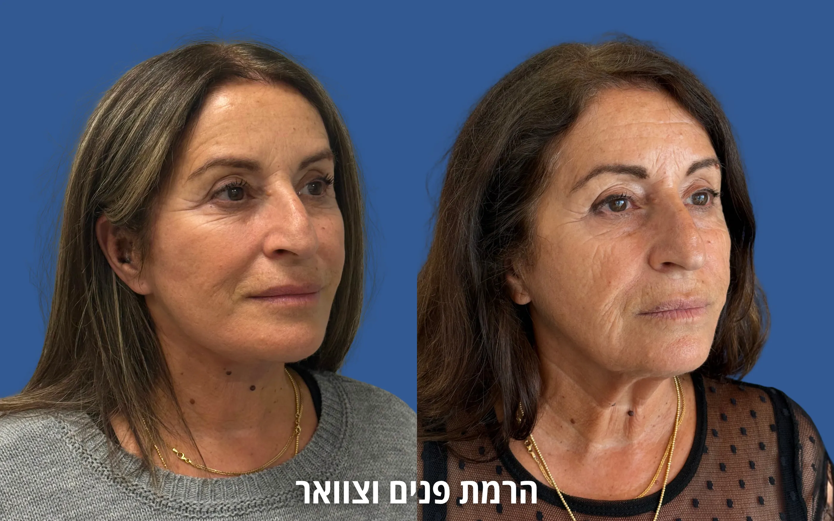 ניתוחי פנים לפני ואחרי אצל ד״ר דוד טל