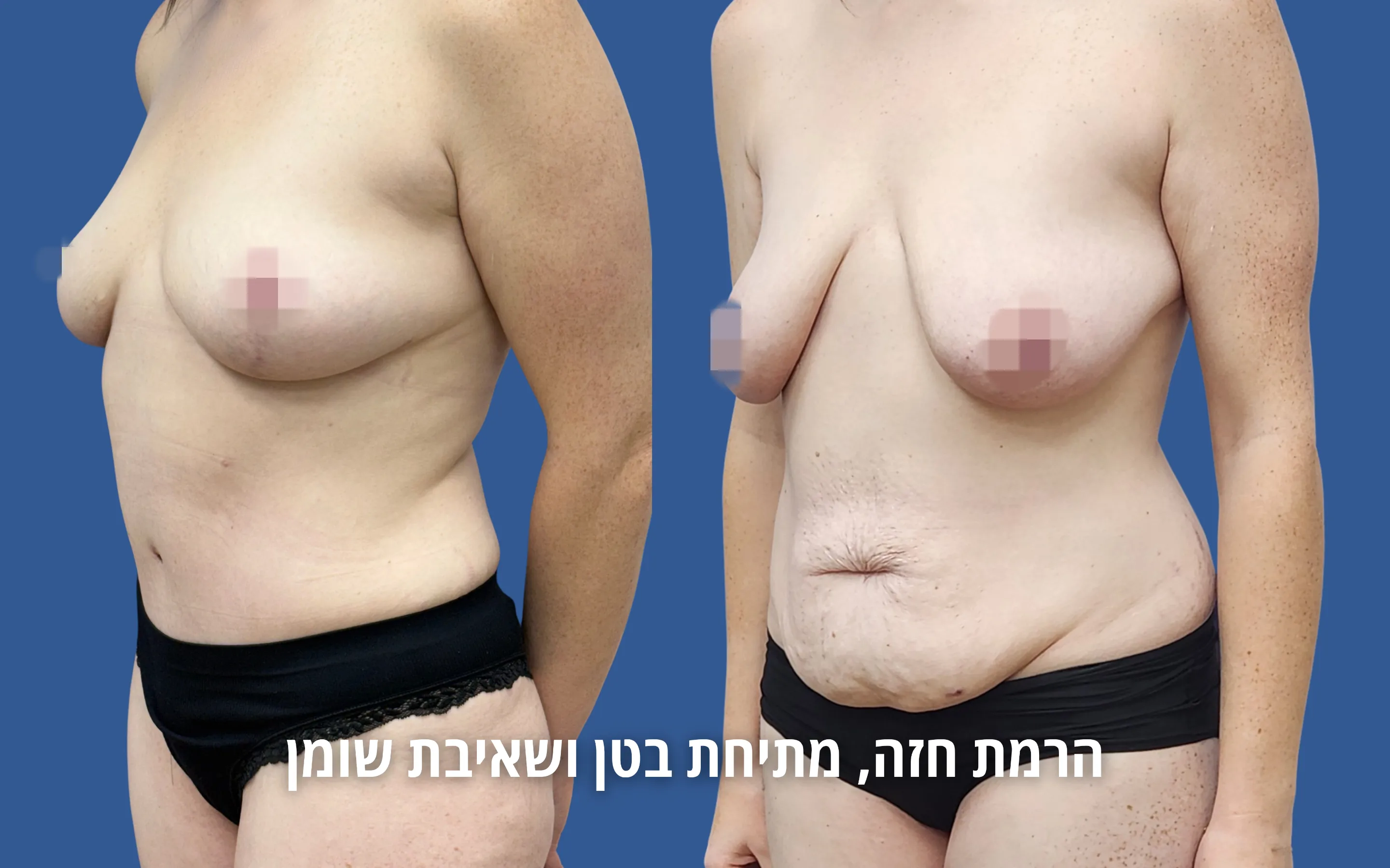 גלריית ניתוחי גוף לפני ואחרי אצל ד״ר דוד טל