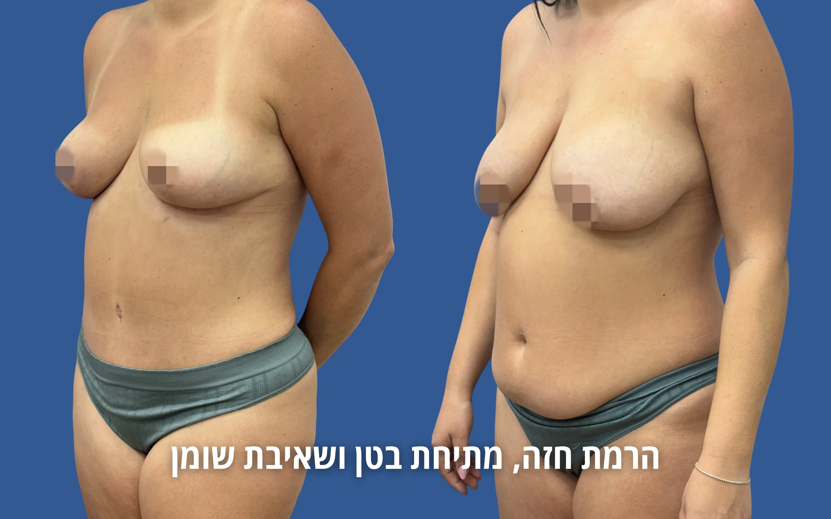 גלריית ניתוחי גוף לפני ואחרי אצל ד״ר דוד טל